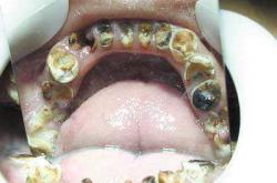 蛀牙补牙-补牙后一般能维持几年